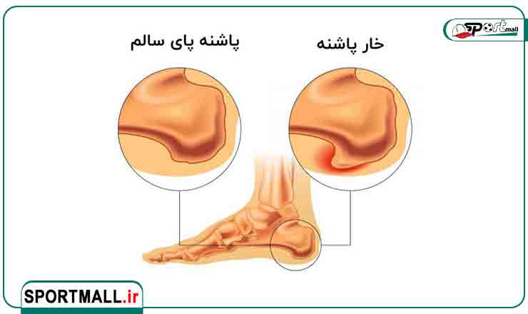 خارپاشنه چیست